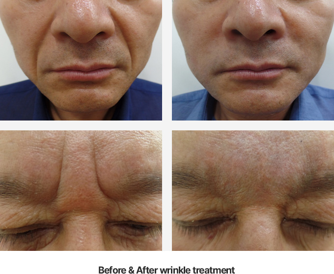 Before and after wrinkle treatment