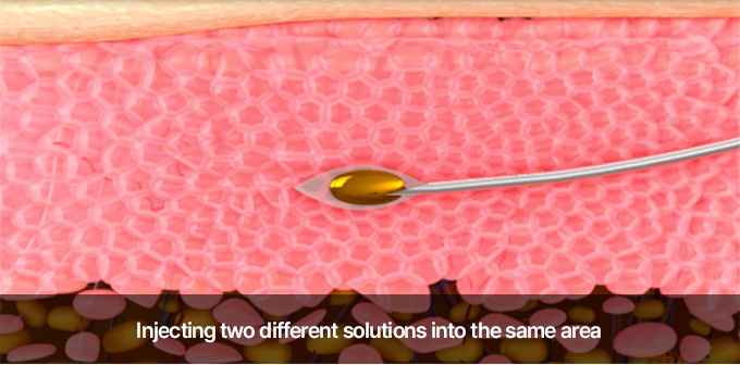 Injecting two different solutions into the same area